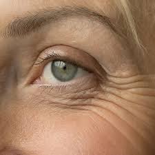 Crows feet lines